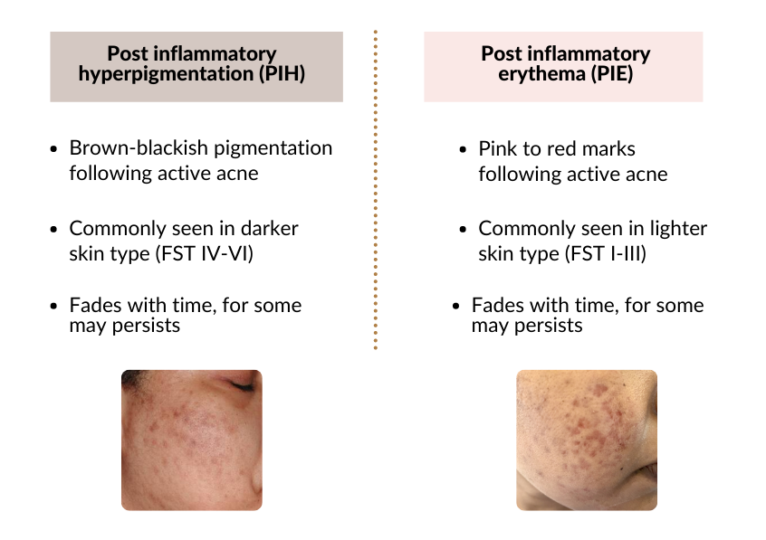 Post Inflammatory Rash Red scars or Post inflammatory erythema | Dr Naphisabet Wanniang