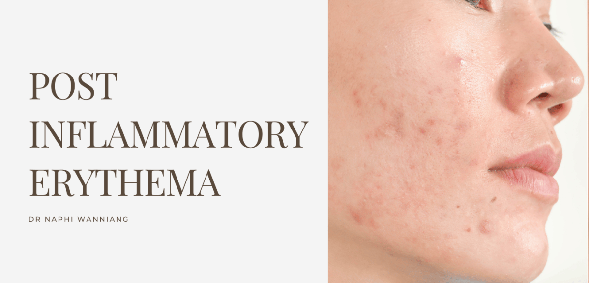 Red scars or Post inflammatory erythema | Dr Naphisabet Wanniang